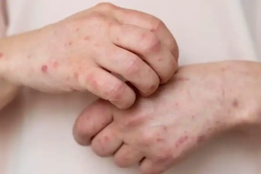 Un tratamiento innovador ofrece esperanza en el manejo del lupus