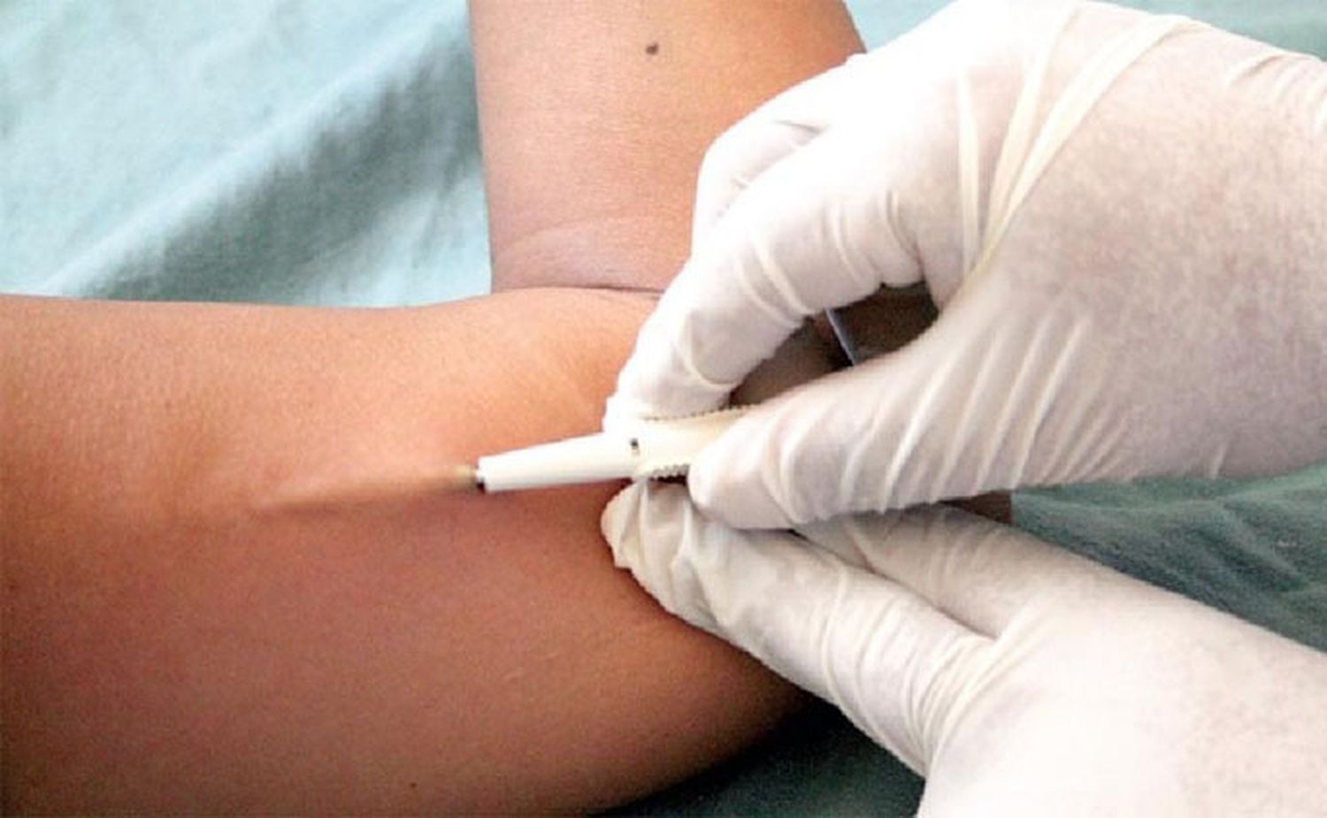 Colocan implantes anticonceptivos gratis