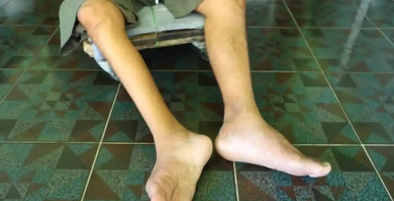 Estados Unidos: detectan el primer caso de poliomielitis en casi una década