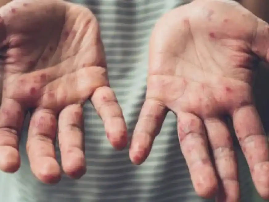 La diputada Drisun criticó la falta de respuesta de Nación ante brote de sarampión.