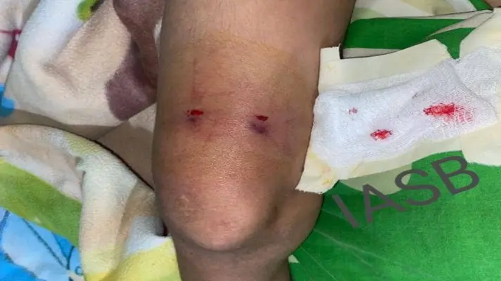 Escasez de suero antiofídico tiene a un niño mordido por mapanare debatiéndose entre la vida la muerte