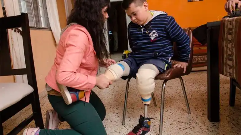Le fabricaron dos prótesis en 3D y volvió a caminar luego de 5 años