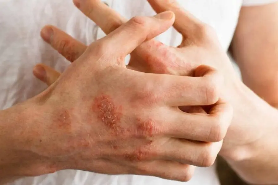 Dia Internacionalde la Psoriasis: En Argentina más  del 40% abandona el tratamiento por falta de recursos