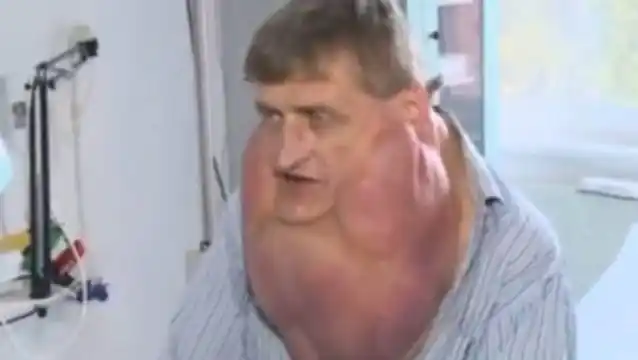 Un hombre pasó 10 años con un tumor de más de cinco kilos en su papada