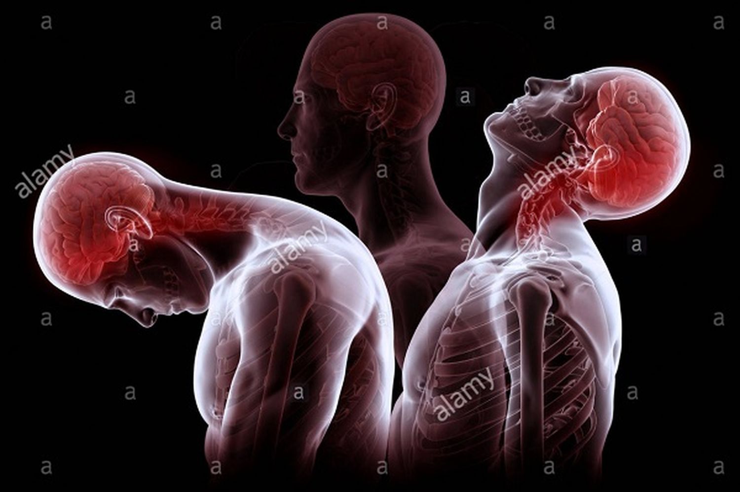 Latigazo cervical o “whiplash”: el esguince del cuello