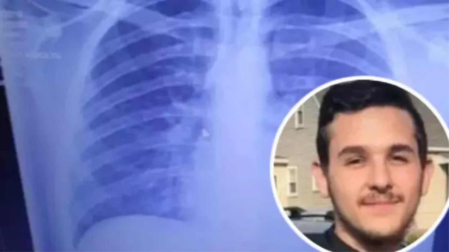 Un joven termina con los pulmones llenos de aceite solidificado por vapear
