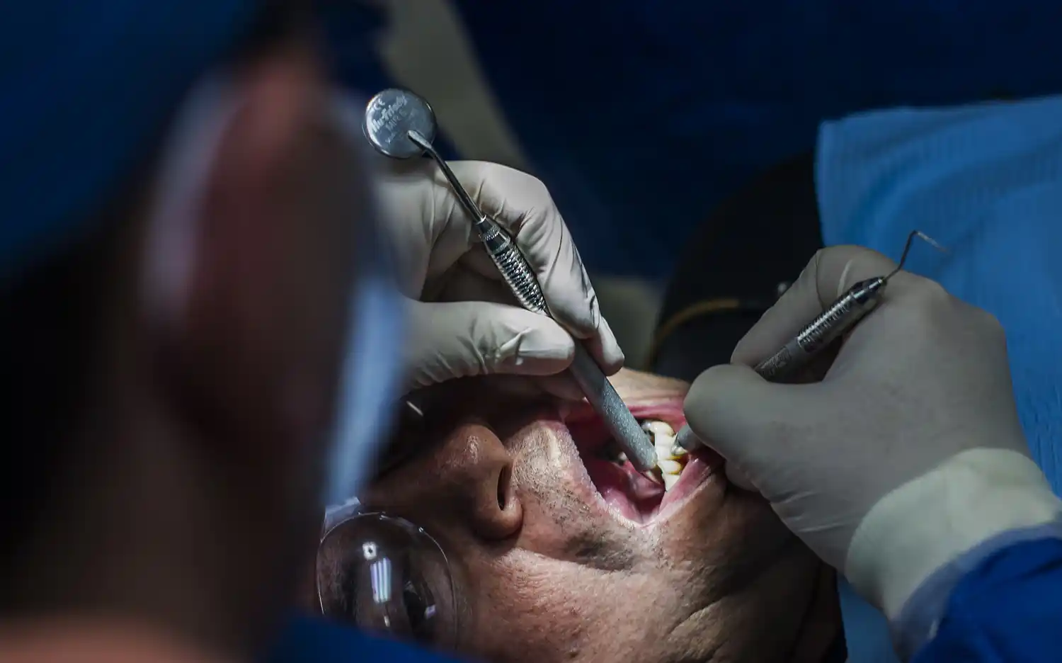 Caries avanzadas e infecciones, las consecuencias de meses sin tratamiento