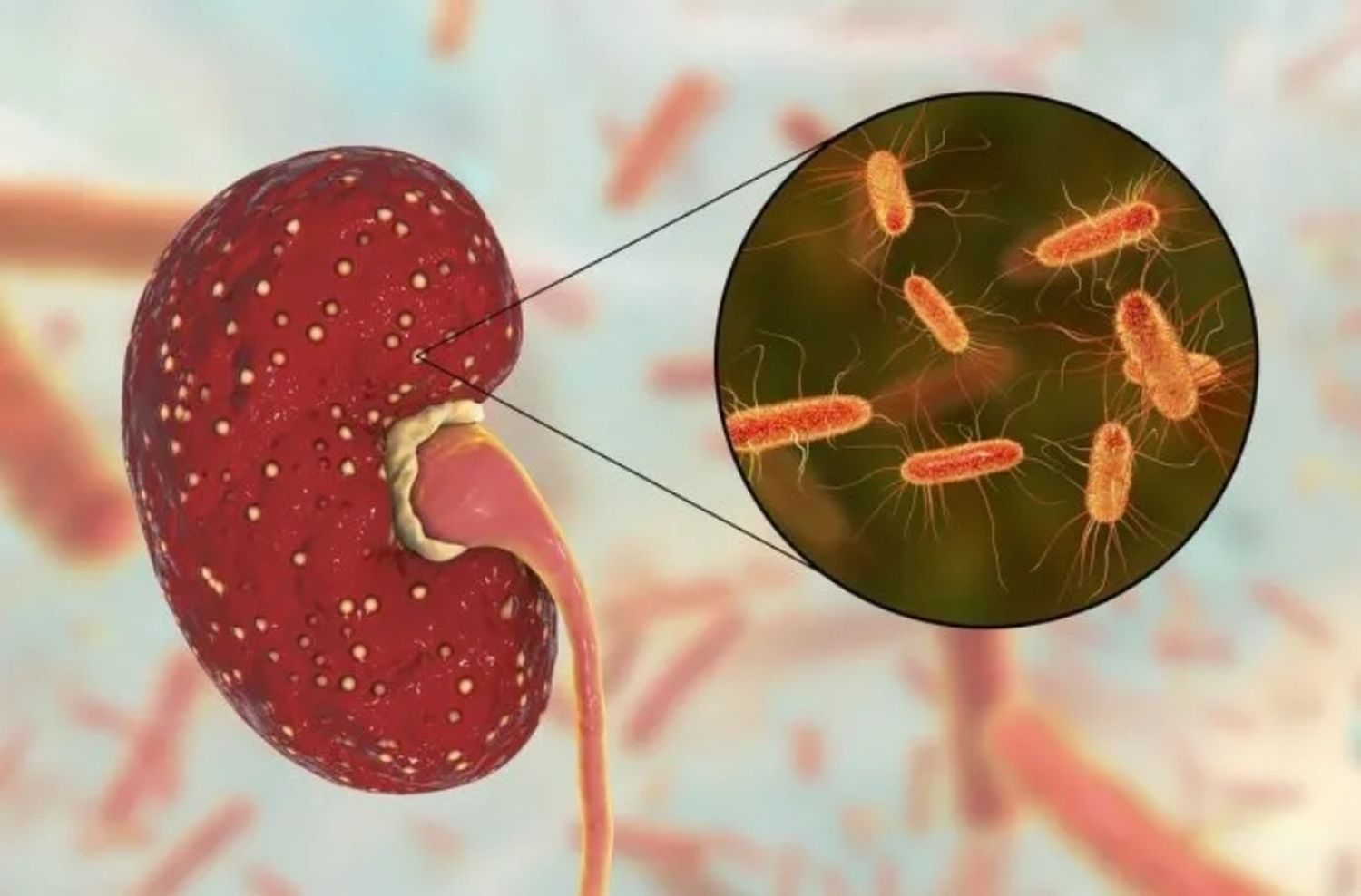 Síndrome Urémico Hemolítico: una enfermedad grave para los menores