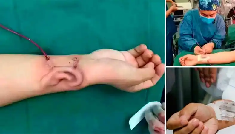 Video: Perdió la oreja en un accidente y se la cultivaron en el brazo