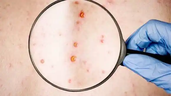 La OMS se reúne de emergencia al superar los 6 mil casos de Viruela del Mono