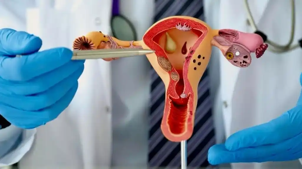 La endometriosis es una patología ginecológica que afecta entre el 10% y el 15% de las mujeres en edad reproductiva.