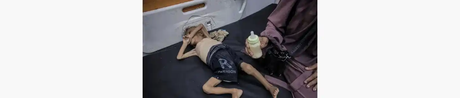 Un niño palestino con desnutrición severa yace en una cama de hospital en el Hospital Amigos del Paciente en la ciudad de Gaza. [Ahmed Jihad Ibrahim Al-arini/Anadolu]