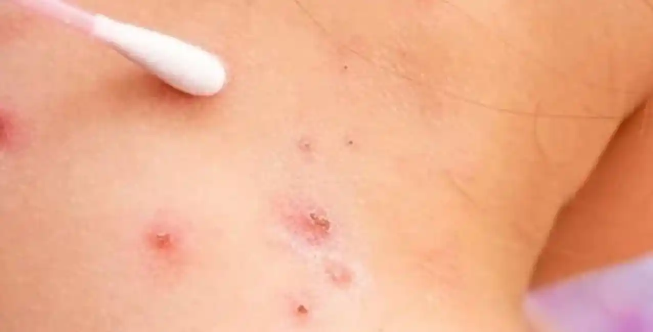 Ya son 13 los casos de viruela del mono en Argentina