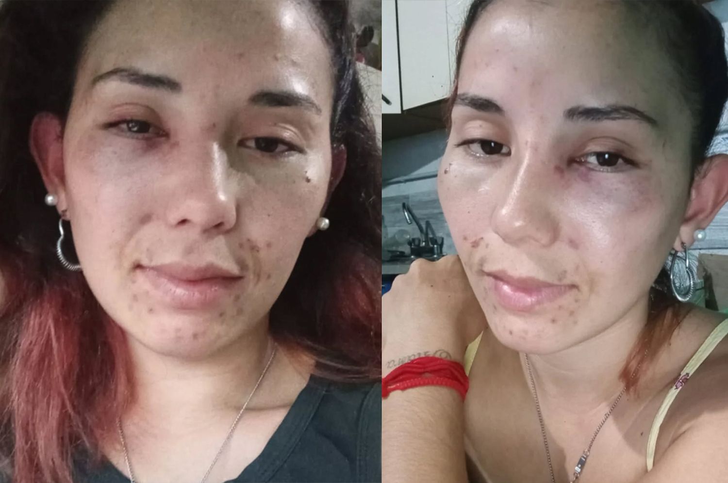 Brinkmann: la joven agredida violentamente fuera de un boliche se recupera en su casa