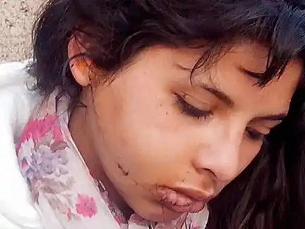 Adolescente atacada por su ex pareja recibió un corte y 30 puntos de sutura