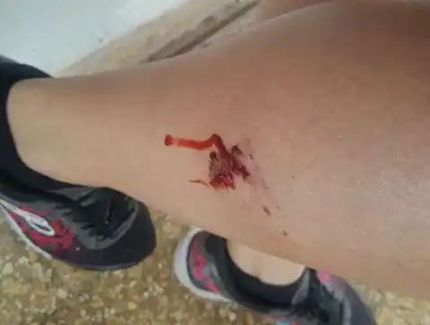 Perros mordieron a una mujer