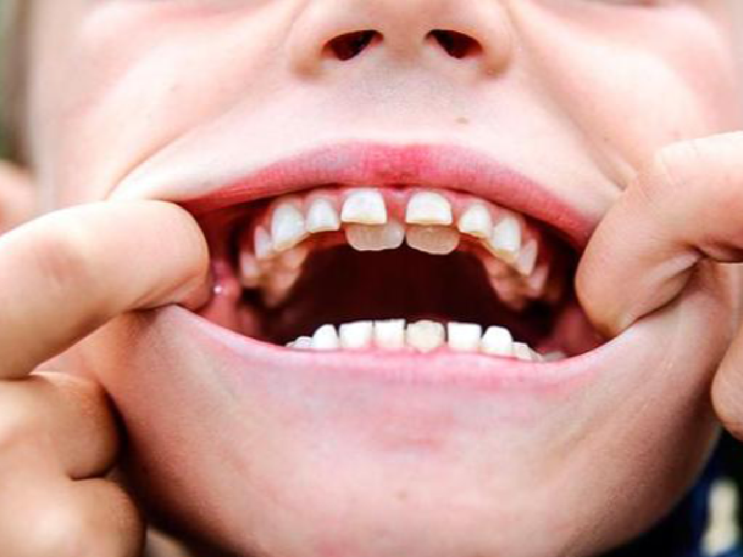Hiperdoncia: por qué hay personas que tienen más dientes que lo normal