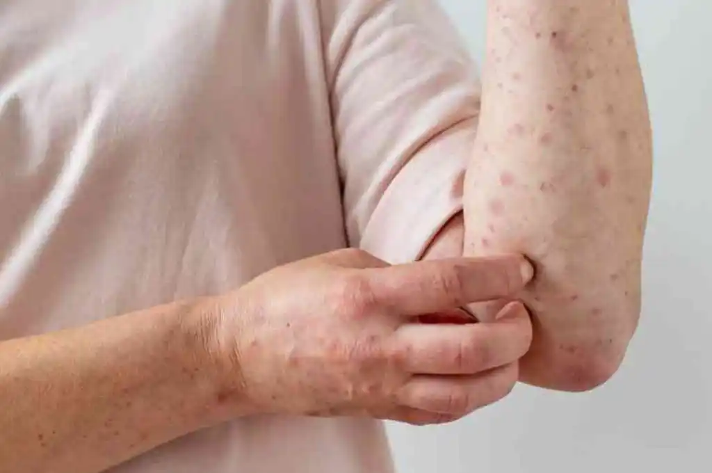 La OMS investiga si la viruela del mono se transmite sexualmente