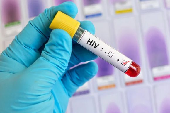 Se registró un nuevo caso de remisión del VIH tras un trasplante de médula ósea