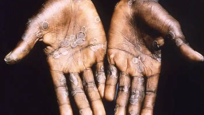 El Ministerio de Salud confirmó que ya son 24 los casos de viruela del mono en el país