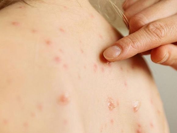 Aseguran que en Mar del Plata “no está circulando” el virus del sarampión