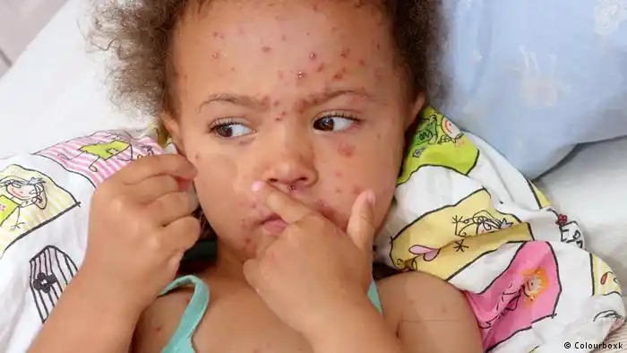 Alerta por tres nuevos casos de sarampión en niños no vacunados