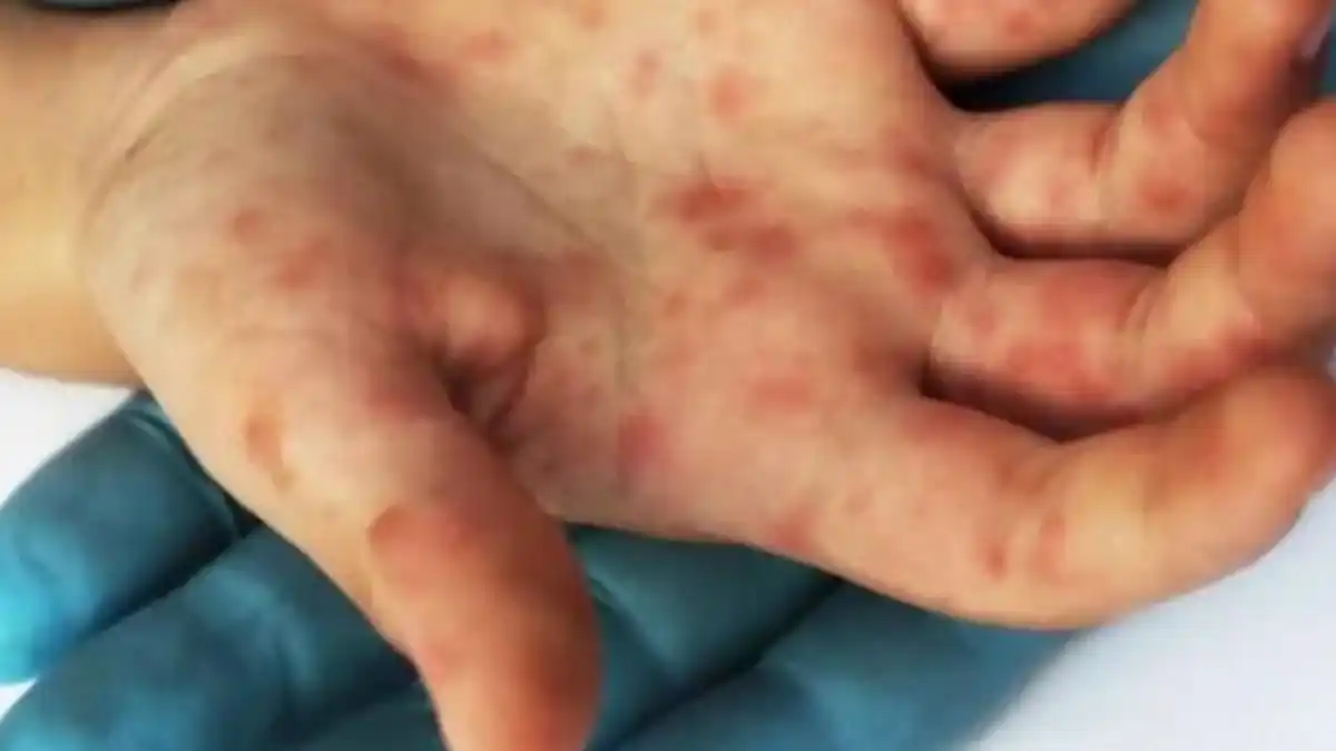 Detectaron el quinto caso de viruela sísmica en la provincia de Santa Fe