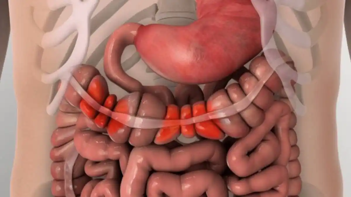 Estos son 6 síntomas de cáncer de colon que debes conocer