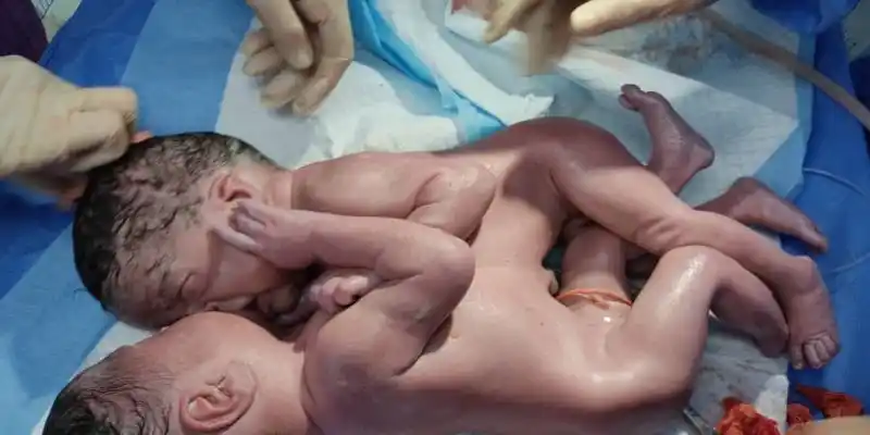 SIAMESAS nacen unidas por tórax y abdomen en Puerto Ordaz