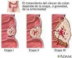 cancer