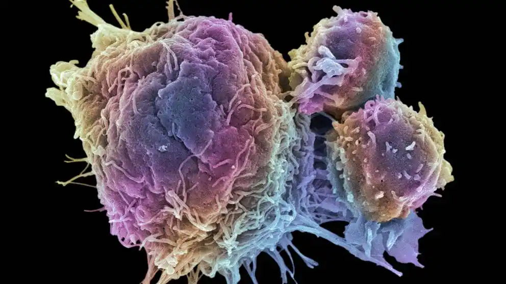 Nuevos fármacos abren una nueva era contra el cáncer de ovario