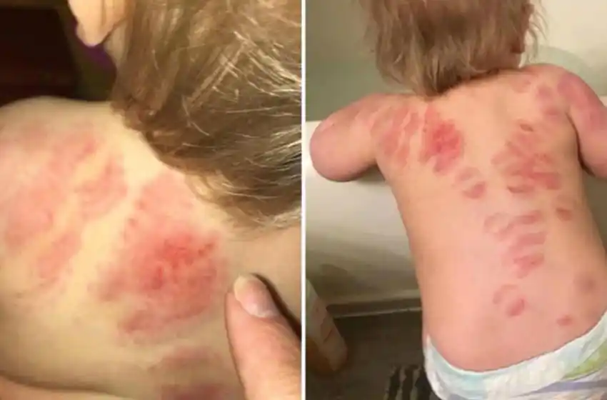 Una mamá retiró a su bebé de la guardería y se dio cuenta que tenía más de 25 marcas de mordidas en el cuerpo