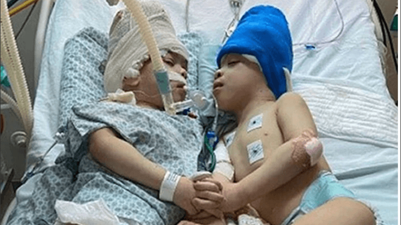 Dos siameses de cuatro años fueron separados con éxito en Brasil