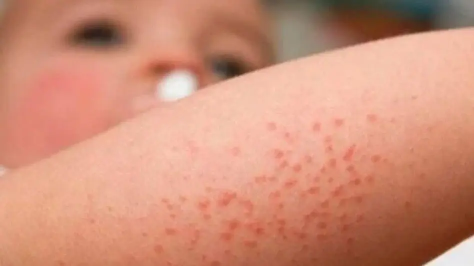 Especialista en Alergia e Inmunología: "Para los pacientes que padecen Dermatitis Atópica altera sus vidas y sus sueños"