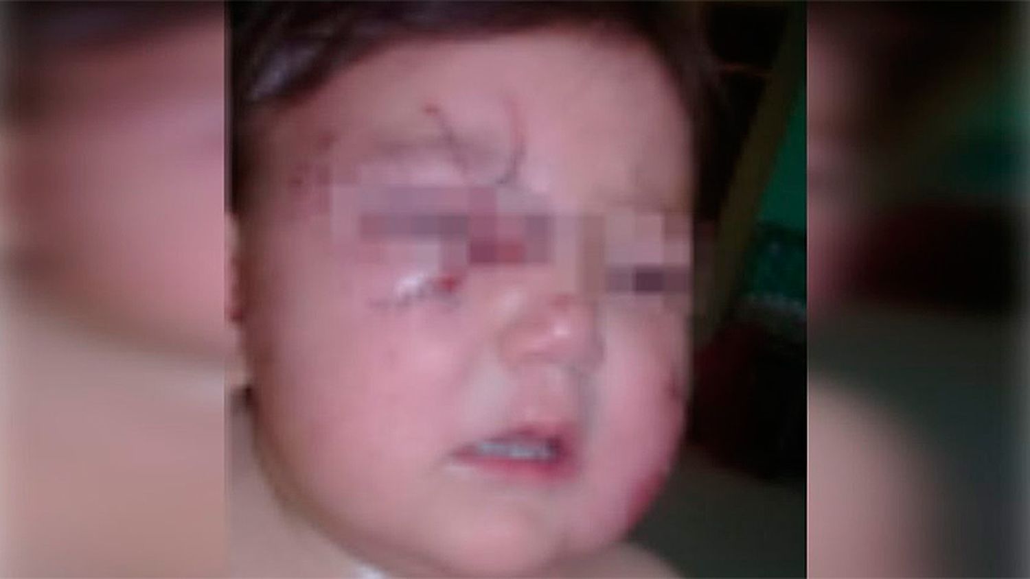 Una beba fue atacada por un perro que le produjo graves heridas en la cara