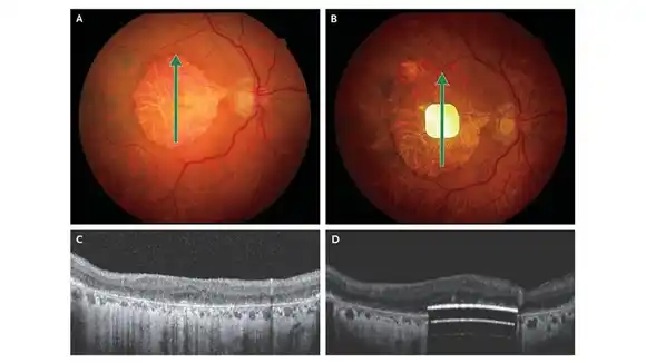 PRIMA: la nueva prótesis ocular logra devolver la visión a personas con ceguera irreversible
