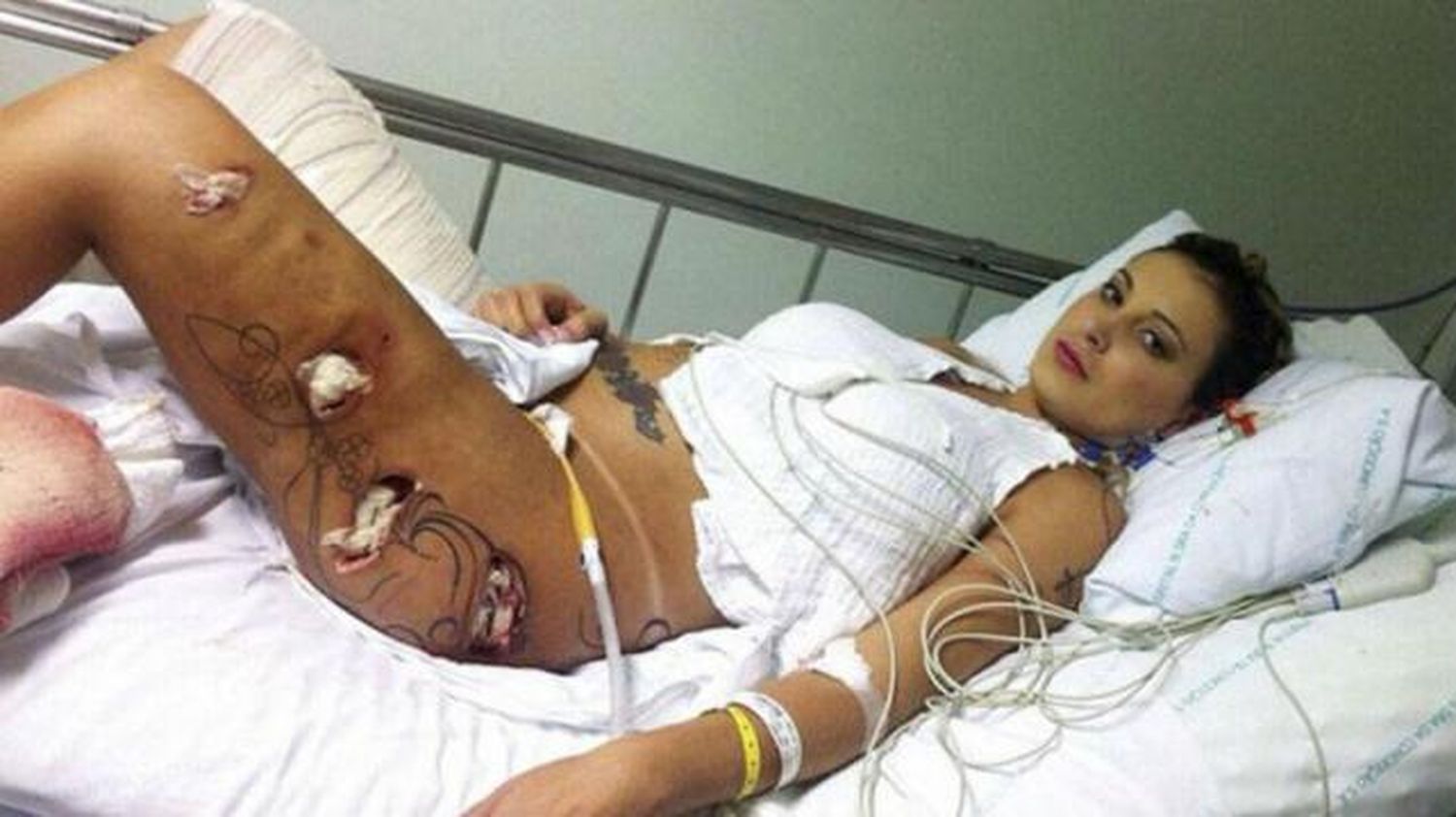 Andressa Urach, Miss Bumbum 2012, mostró las brutales secuelas de sus cirugías