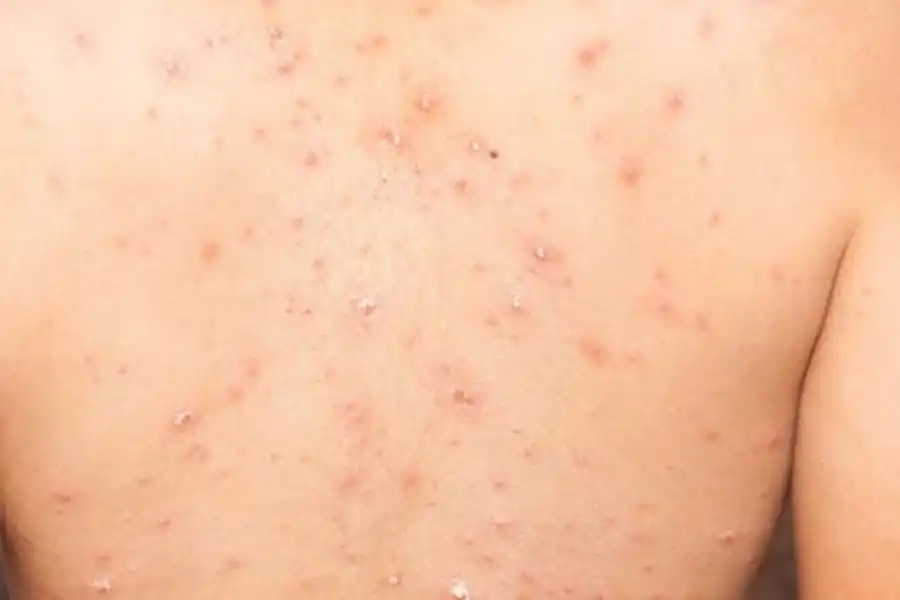 Salud evalúa un segundo caso sospechoso tras confirmar primer contagio en Argentina