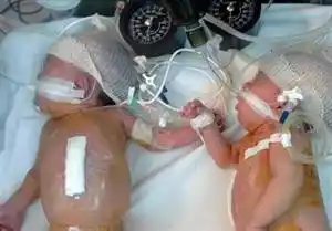 Lograron separar a siamesas unidas por el abdomen