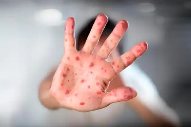 Argentina podría dejar de ser "país libre de sarampión" si el brote continúa