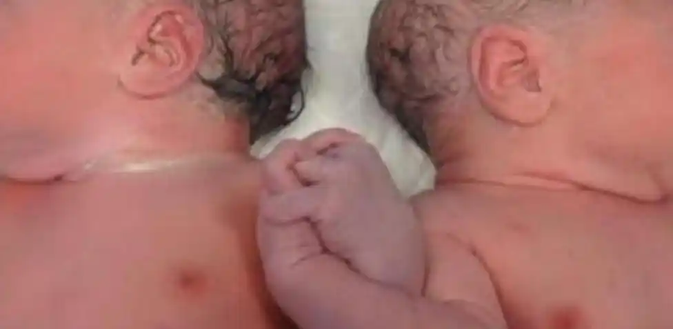 Mujer tuvo gemelos que nacieron en años distintos