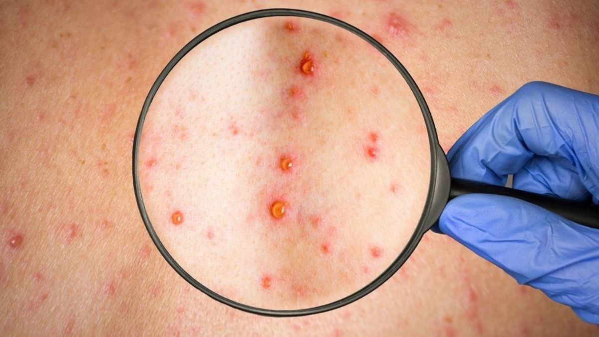 EN CLAVES: todo lo que debe saber sobre la viruela del mono