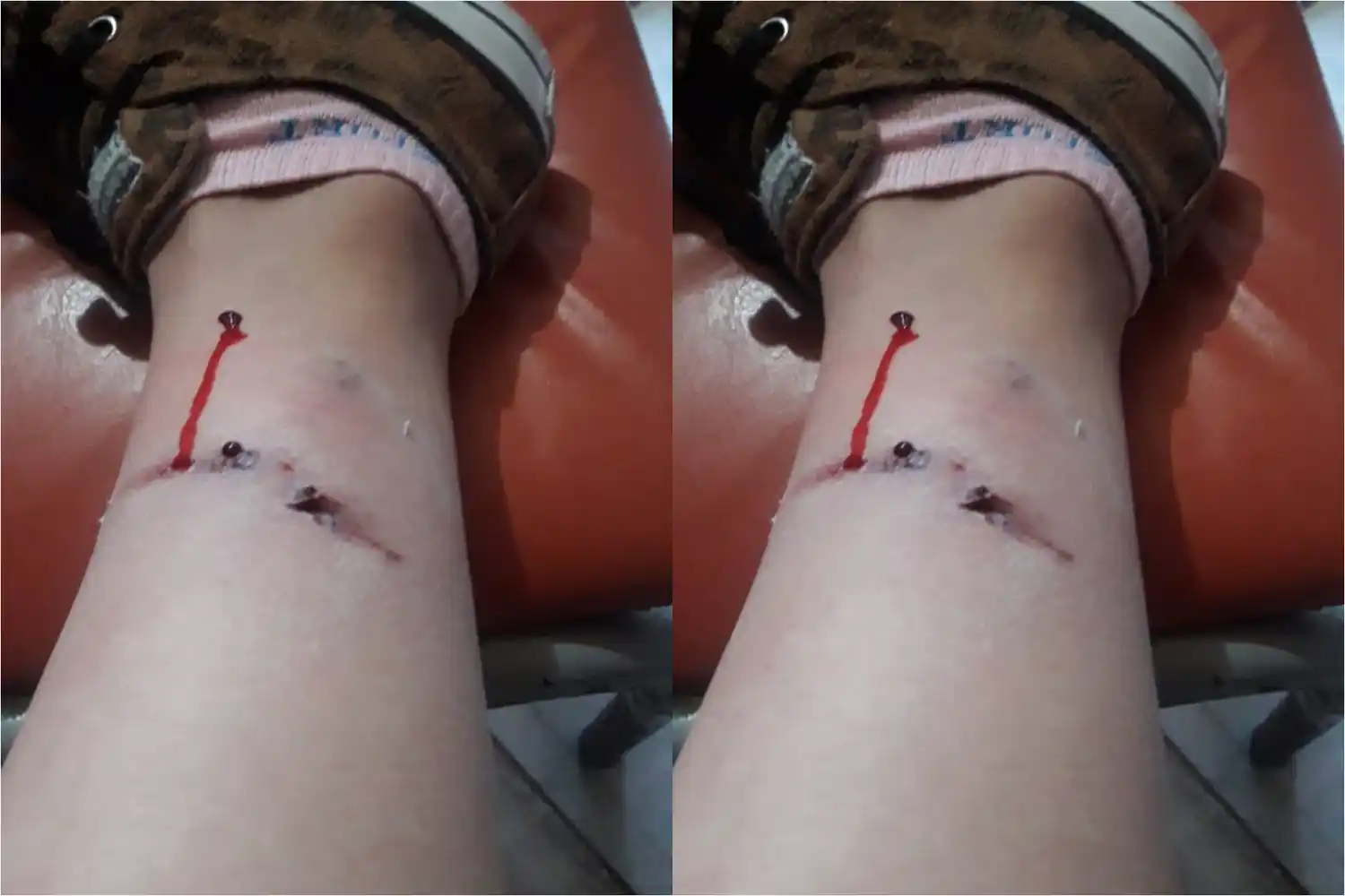 Perros en la costanera: mordieron a un joven que iba en moto