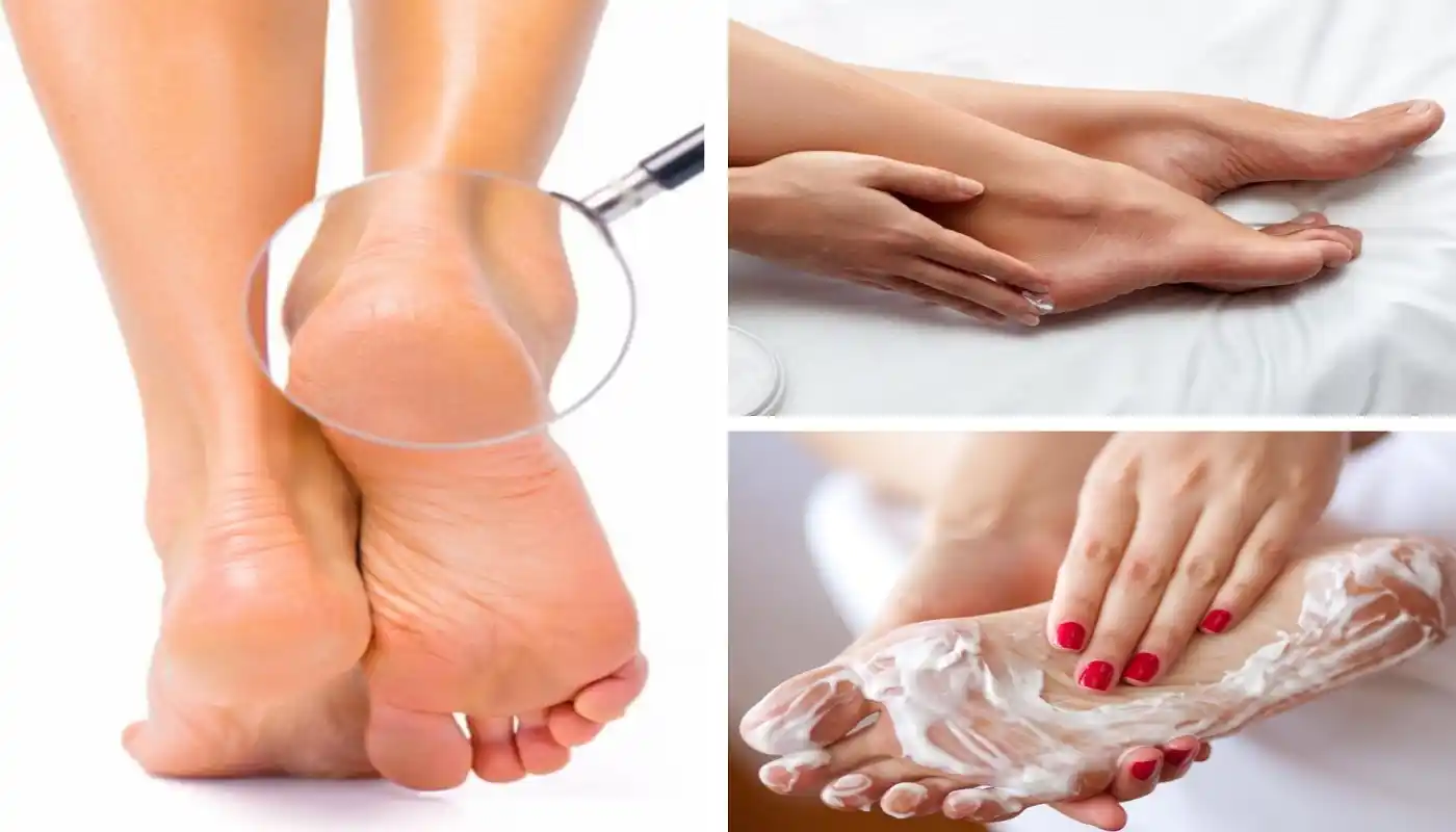 DILE ADIÓS A LOS PIES RESECOS con este ungüento casero – VIDEO