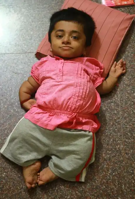 Tiene 19 años pero está encerrada en el cuerpo de una niña de 2