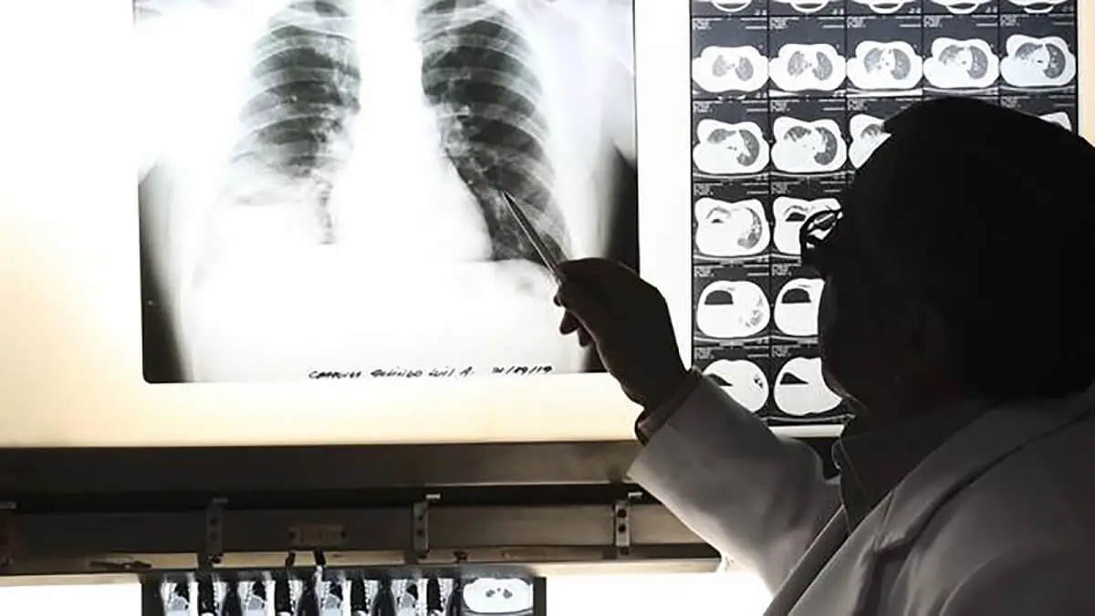 ¡EN PELIGRO! Aumenta cantidad de trabajadores de la salud que se infectan de tuberculosis