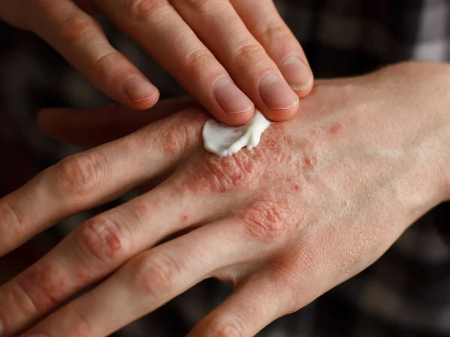 29 de octubre: Día Mundial de la Psoriasis, una historia que se cuenta desde la piel