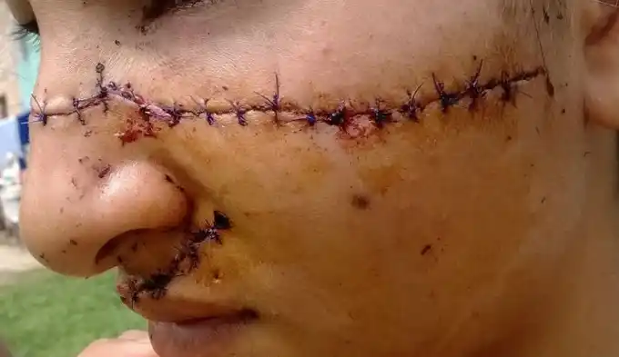 Impactante: le desfiguraron la cara "por ser linda"