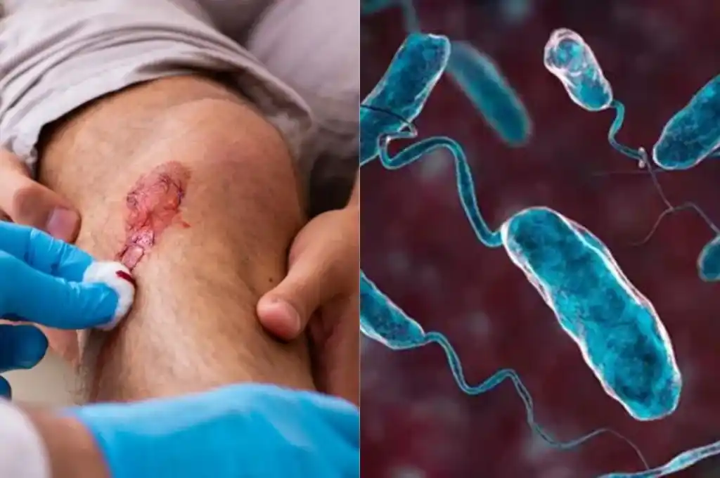 Se estima que 80.000 personas se infectan con la bacteria en EE.UU. cada año.