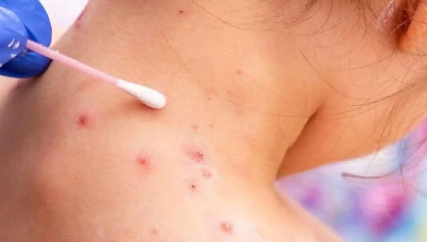 Dos casos nuevos de viruela del mono en Córdoba.